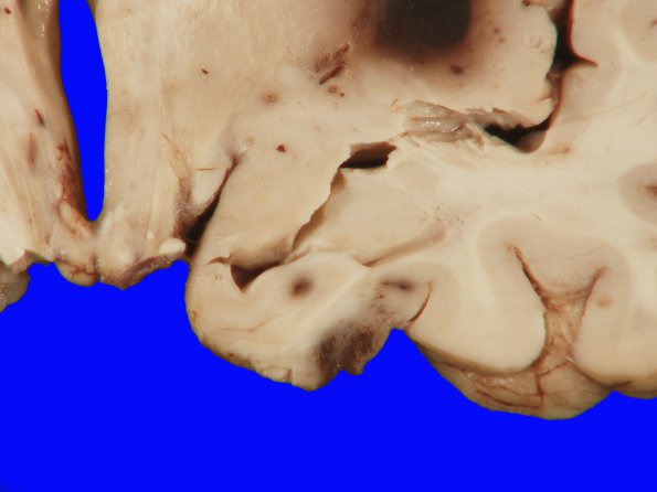 12B5 Herniation, Uncal (SDH, Case 12) Gross_10