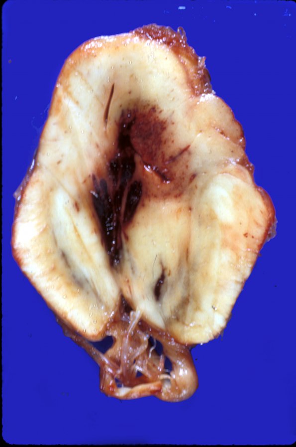 13C Herniation, Duret (Case 13C)