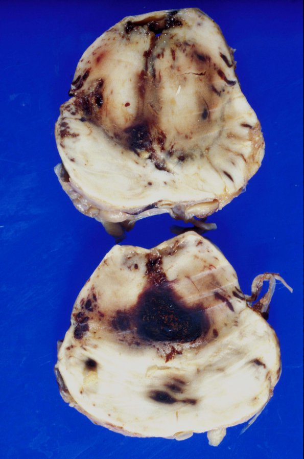 13D Hemorrhage, Duret (Case 13D) Subdural