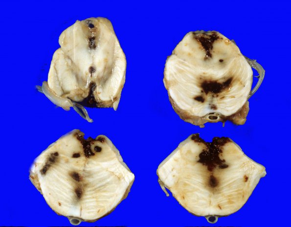 13E Herniation, Duret Hemorrhages (Case 13E)