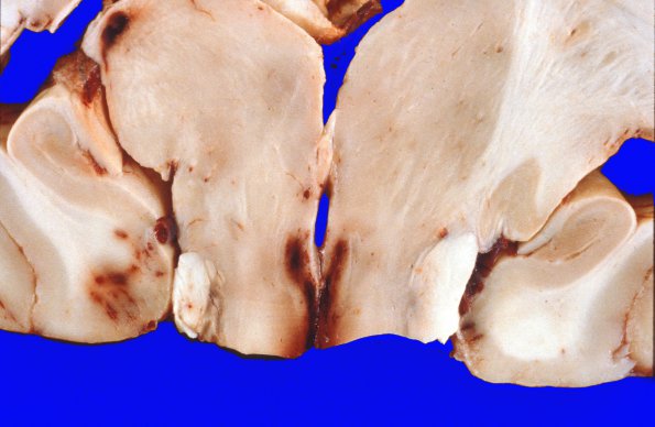 13F Herniation, Uncal thalamus (Case 13F)