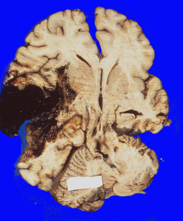 13G Herniation, Uncal (Case 13G)