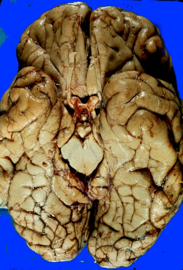 14A1 Herniation (Case 14A) 1