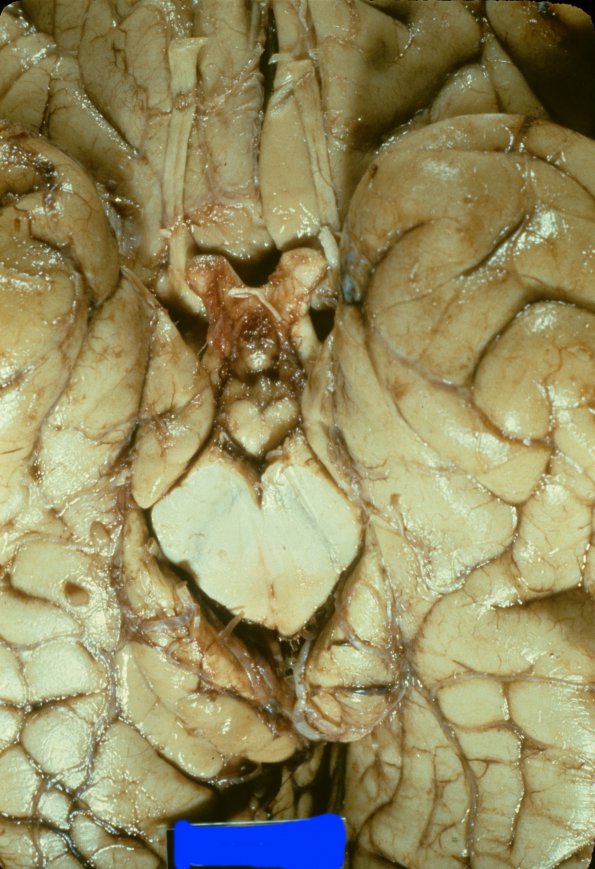 14A2 Herniation (Case 14A) 2