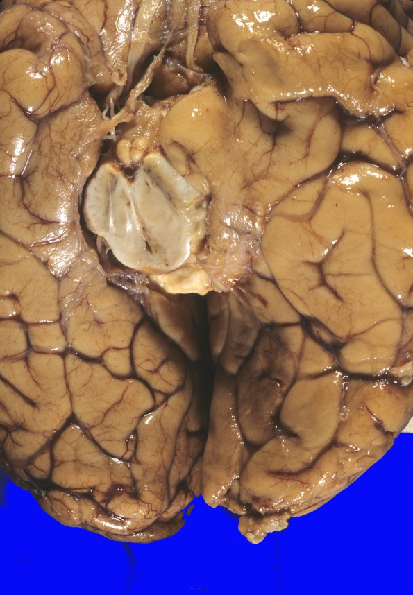 14C Herniation, uncal (Case 14C)