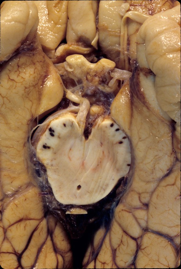 14D Herniation, uncal, hemorrhage peduncles (Case 14D) 1
