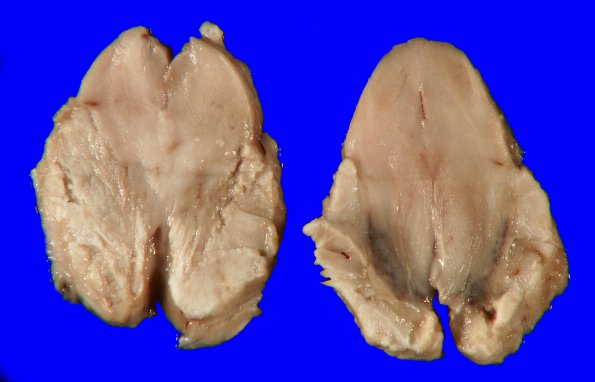 14H Herniation, uncal, AP (Case 14H) 1