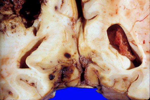 15A2 Herniation, PCA infarcts (Case 15A) a