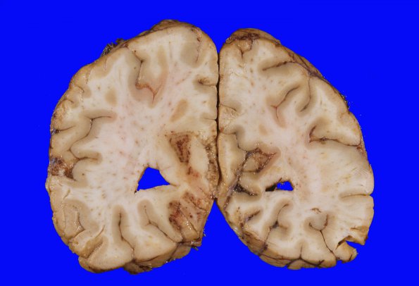 15B1 Herniation, uncal & PCA infarcts (Case 15B) 1