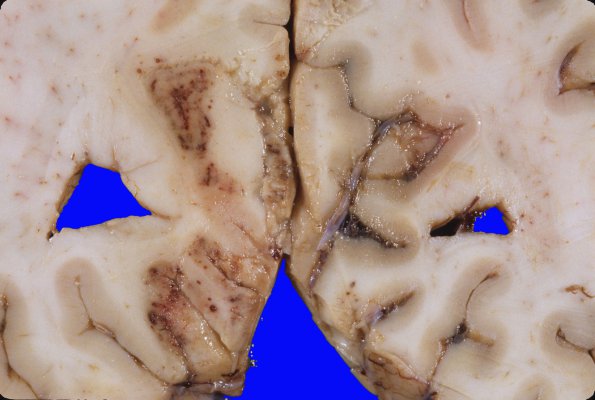 15B2 Herniation, uncal  & infarcts (Case 15B) 2