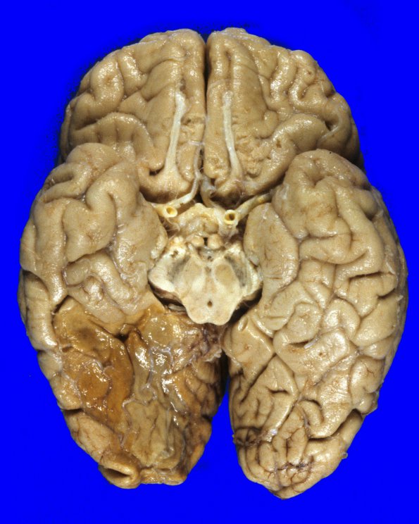 15C Herniation, uncal (Case 15C) 1