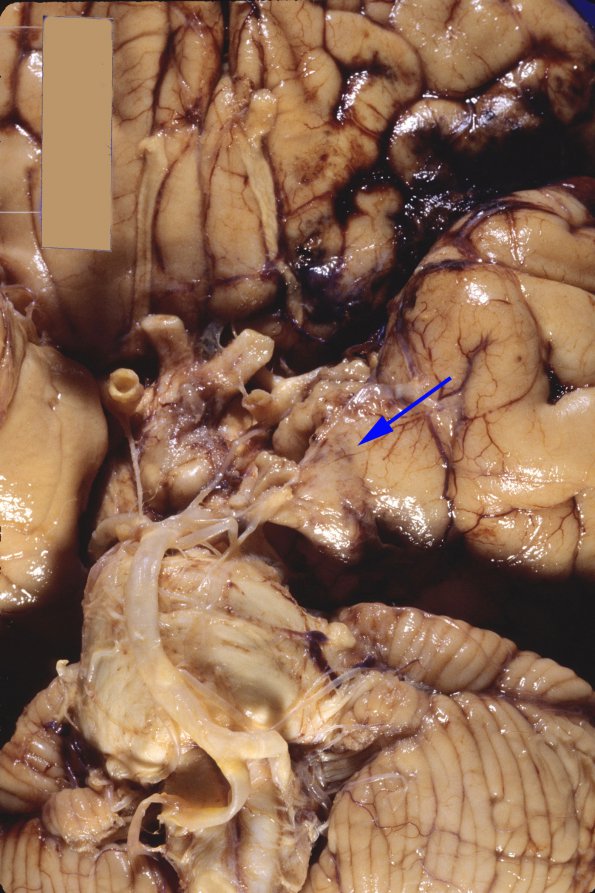 1A1 Herniation, uncal & Duret (Case 1) copy