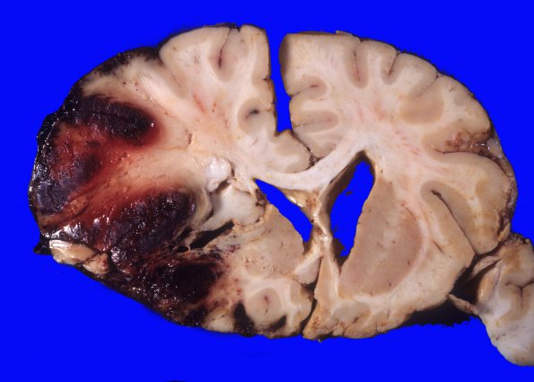 1A2 Herniation, uncal & Duret (Case 1) 5