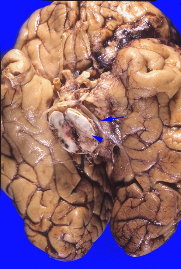 1A3 Herniation, uncal & Duret (Case 1) 1