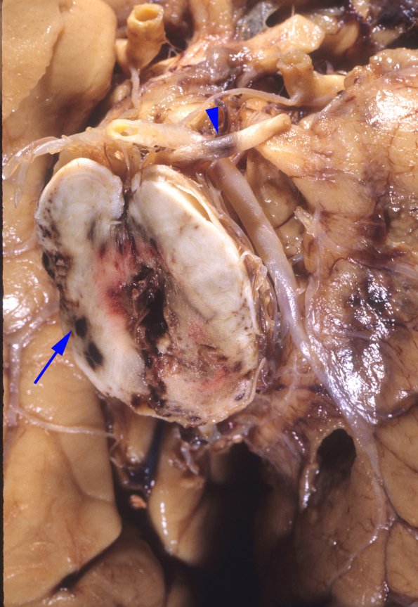 1A4 Herniation, uncal & Duret (Case 1) 2 copy