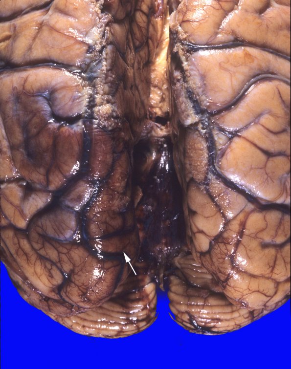 1A5 Herniation, uncal & Duret (Case 1) 4 copy