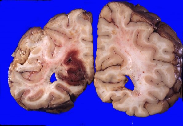 1A6 Herniation, uncal (A34454) & PCA infarcts 6