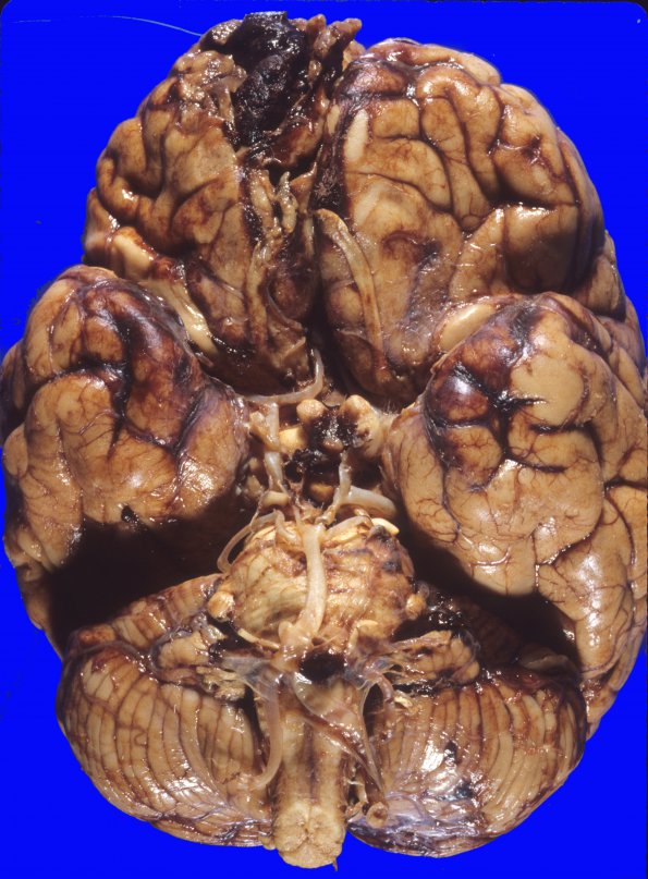 2A1 Aneurysm, saccular, ACA (Case 2) 7