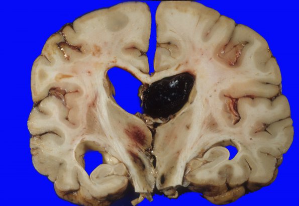 2A3 Herniation, uncal & Duret (Case 2) 7