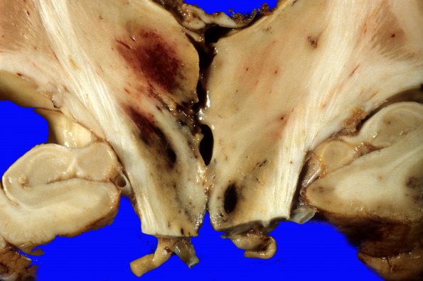 2A4 Herniation, uncal & Duret (Case 2) 1 (2)