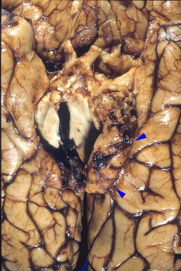 3A2 Herniation, uncal (Case 3) 1 copy