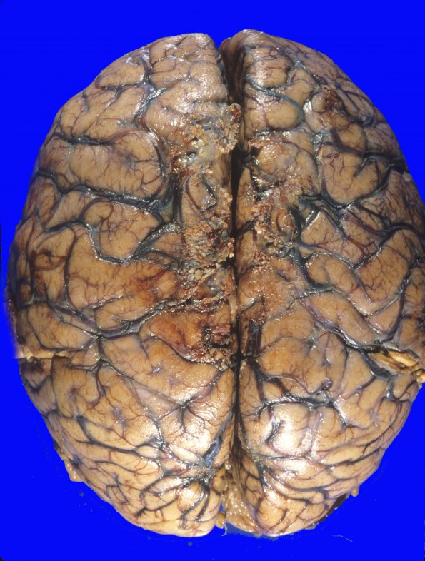 4A1 Edema & Herniation, uncal (Case 4) 4