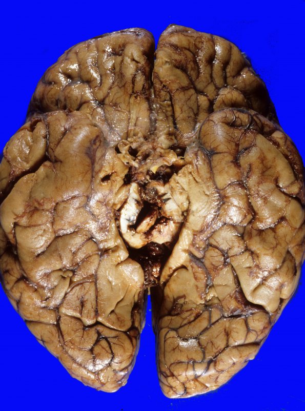 4A4 Edema & Herniation, uncal (Case 4) 1