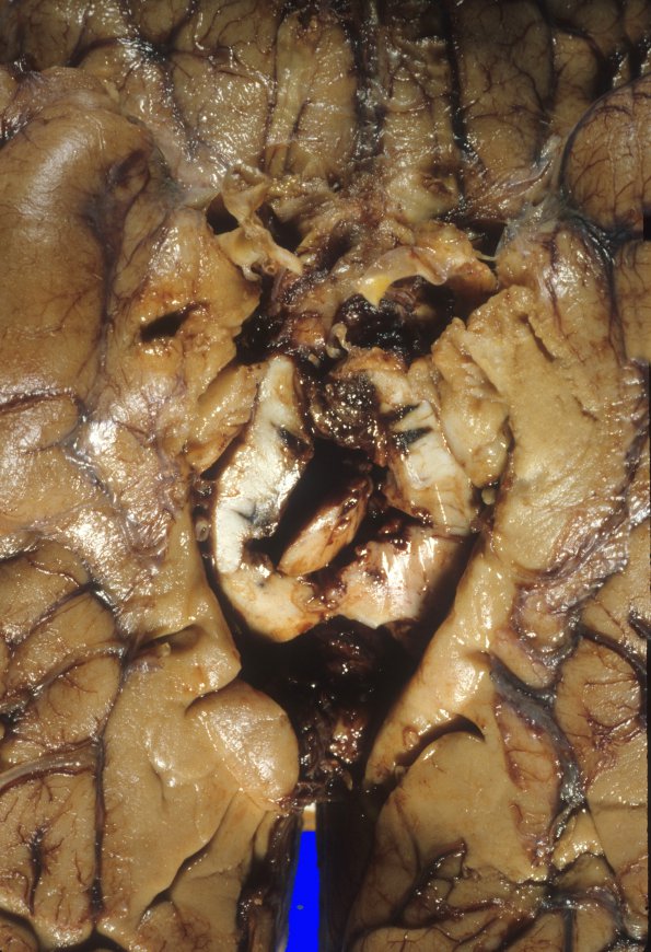 4A5 Edema & Herniation, uncal (Case 4) 6