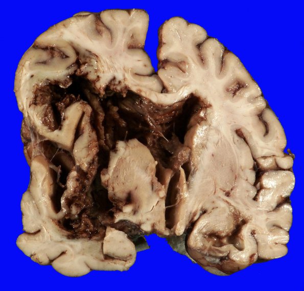 5B1 Hemorrhage, HT uncal (Case 5) Gross_5