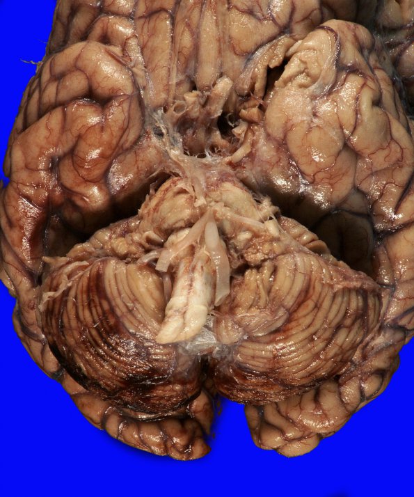 5B2 Hemorrhage, HT,  (Case 5) 2