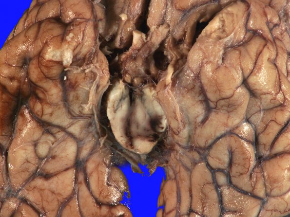 5B3 Hemorrhage, HT, (Case 5) 4 (2)