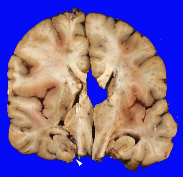 6A1 Herniation, uncal (Case 6) 2 copy