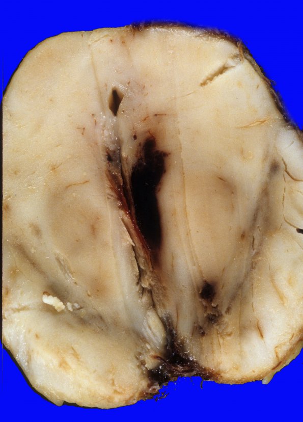 6A2 Herniation, uncal (Case 6) 1