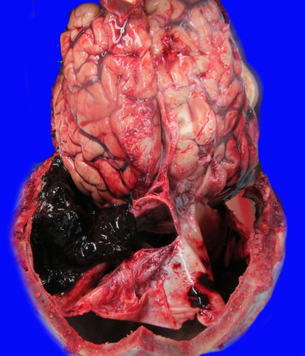 7B1 Hemorrhage, SDH, with Herniation (Case 7)_2