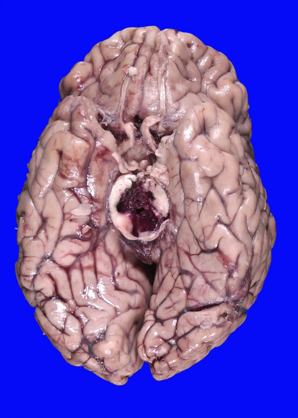 7B2 Hemorrhage, subdural (SDH) uncal H (Case 7)_3