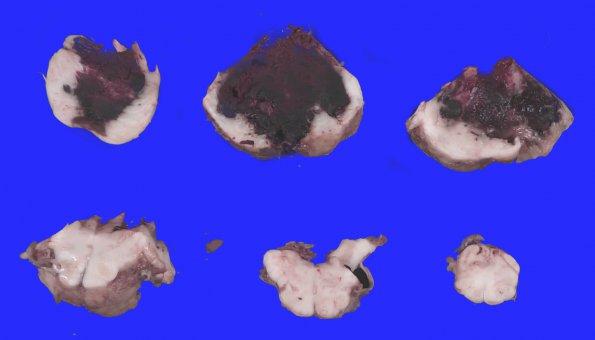 7B3 Hemorrhage, subdural (SDH) uncal (Case 7)_10