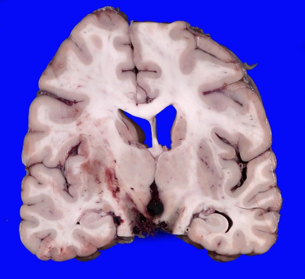 7B4 Hemorrhage, subdural (SDH) uncal (Case 7)_7