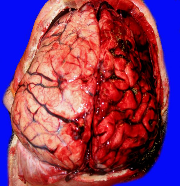 8B1 SDH, uncal herniation (Case 8) 1