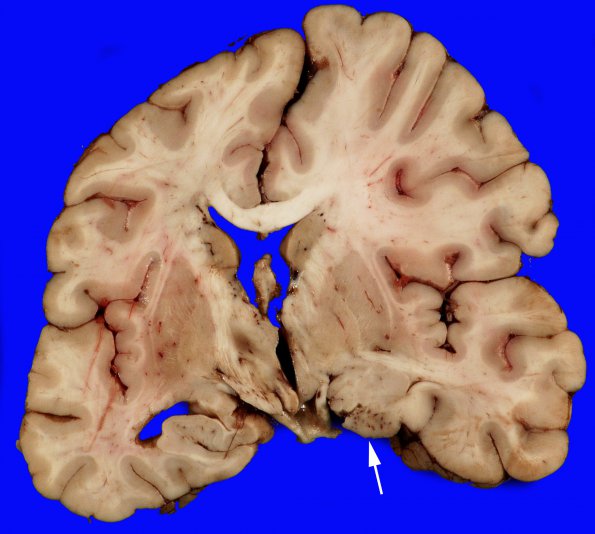 8B3 SDH, uncal herniation (Case 8) 6 copy