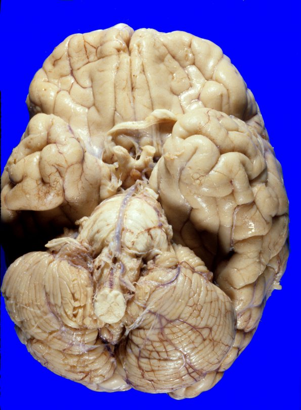 9A1 Herniation, Duret (Case 9) 2 (2)