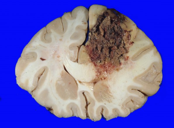 9A3 Herniation, Duret (Case 9) 1