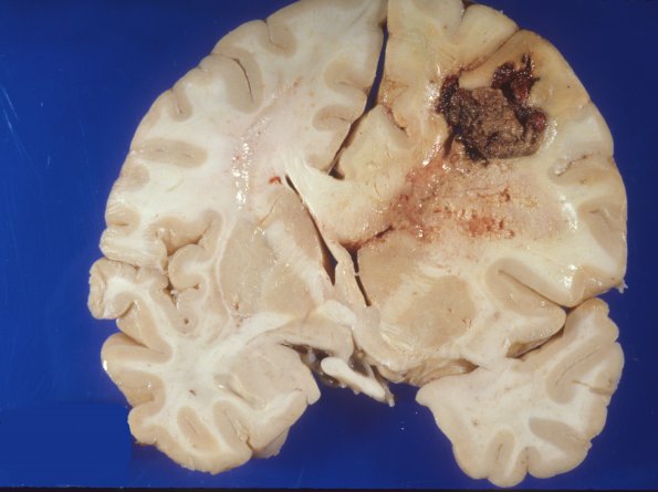 9A4 Glioblastoma (Case 9) gross 2