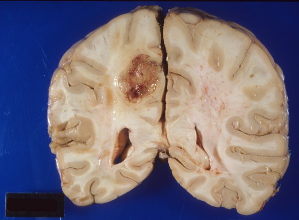 9A5 Glioblastoma (Case 9) 5