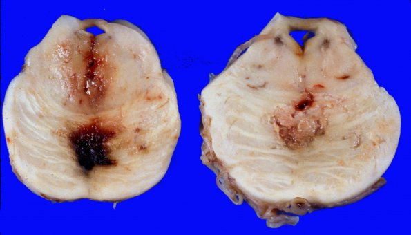 9A6 Herniation, Duret (Case 9)