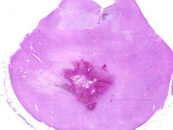 9B1 Hemorrhage Duret (Case 9) H&E WM