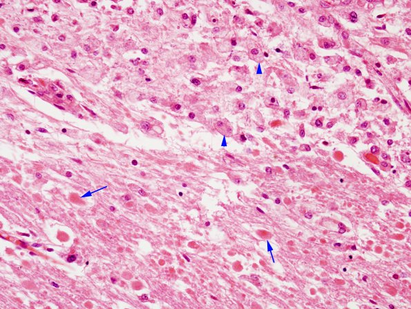 9B2 Hemorrhage Duret (Case 9) H&E 2 copy