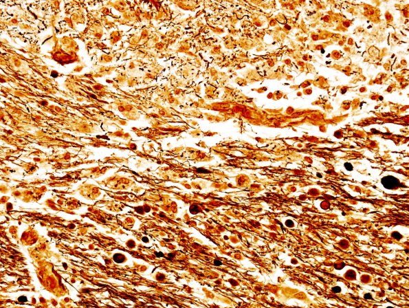 9C  Hemorrhage Duret (Case 9)  Biels 1