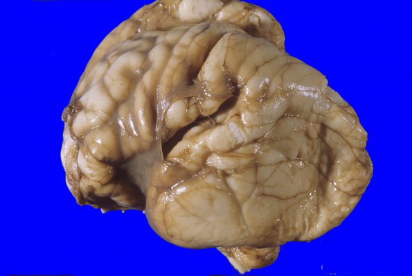 1A1 Hydrocephalus following IVH (Case 1) 3