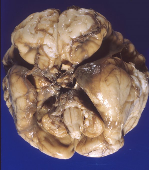 1A2 Hydrocephalus following IVH (Case 1) 2