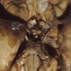 1A3 Hydrocephalus following IVH (Case 1) 1